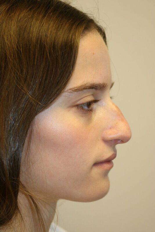 Non-Surgical Nose Job Before & After Image