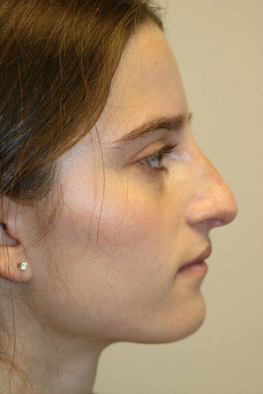 Non-Surgical Nose Job Before & After Image